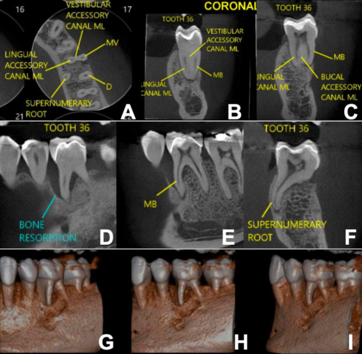 Efficacy of Biodentine as an Intraorifice Barrier in a Cracked Tooth with Endo-periodontal Lesions: A Case Report.