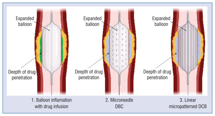 Drug-coated balloons in percutaneous coronary interventions: existing evidence and emerging hopes.