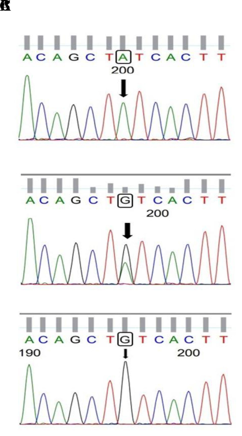 Association of The <i>MCP-1</i> rs1024611 Polymorphism with Polycystic Ovary Syndrome in A Population of Indian Women: A Case-Control Study.