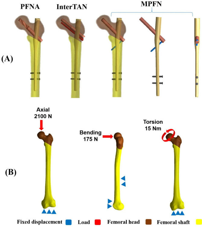 Biomechanical evaluation of the modified proximal femoral nail for the treatment of reverse obliquity intertrochanteric fractures.