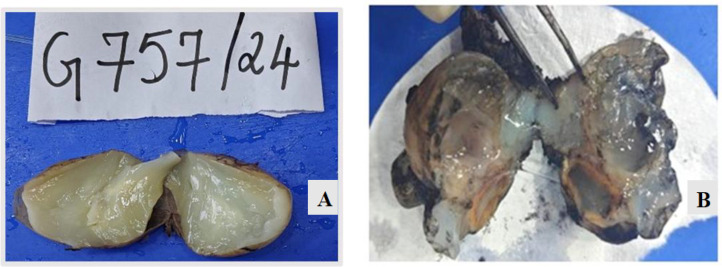 Low Grade Appendiceal Mucinous Neoplasm - A Case Series A Silent Threat with Deadly Consequences.