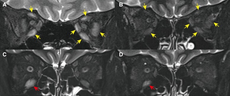 Concomitant Exacerbation of Graves Orbitopathy and Double-Seronegative Myasthenia Gravis after SARS-CoV-2 Infection.