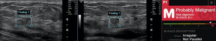 Artificial Intelligence in Diagnostic Breast Ultrasound: A Comparative Analysis of Decision Support Among Radiologists With Various Levels of Expertise.
