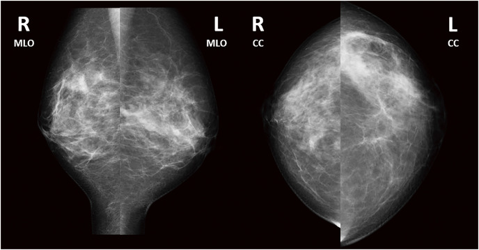 A Case of Cystic Neutrophilic Granulomatous Mastitis in Which <i>Mycobacteroides abscessus</i> Was Detected.