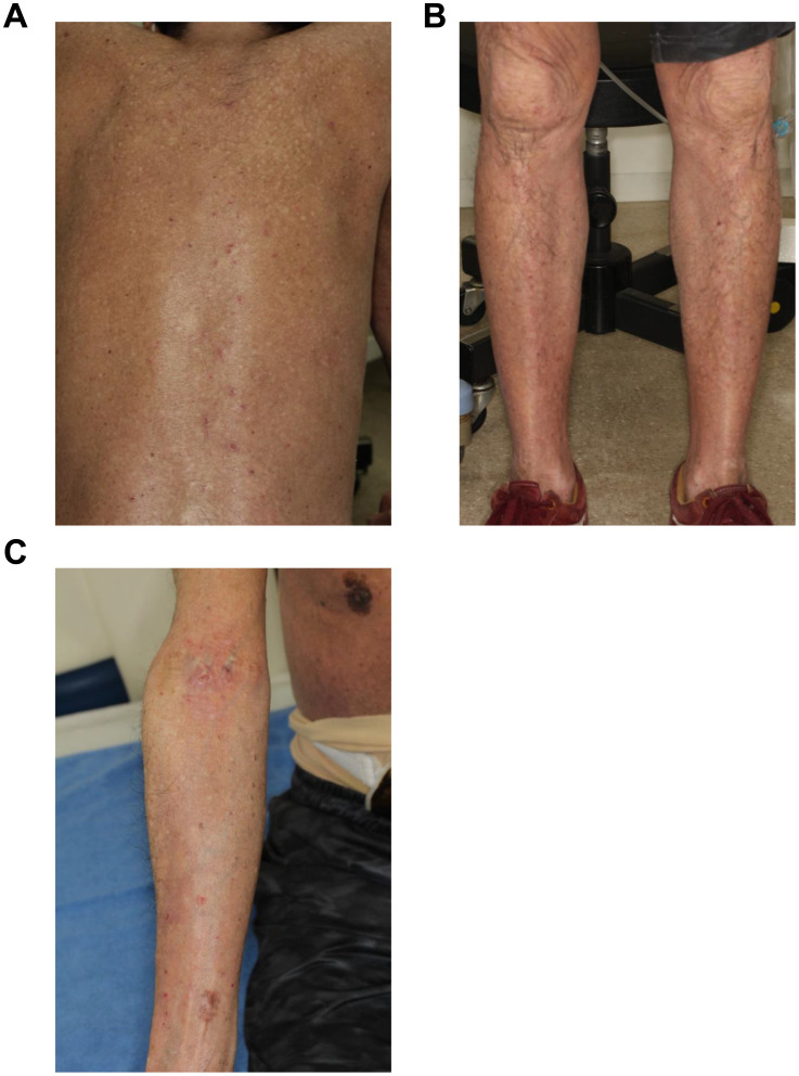 ALK-negative anaplastic large cell lymphoma with TP53 mutation developing during the administration of baricitinib for atopic dermatitis - A case report.