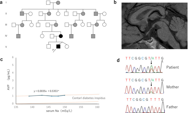 Identification of a novel missense variant in the <i>AVP</i> gene in a Japanese pedigree with familial neurohypophyseal diabetes insipidus.