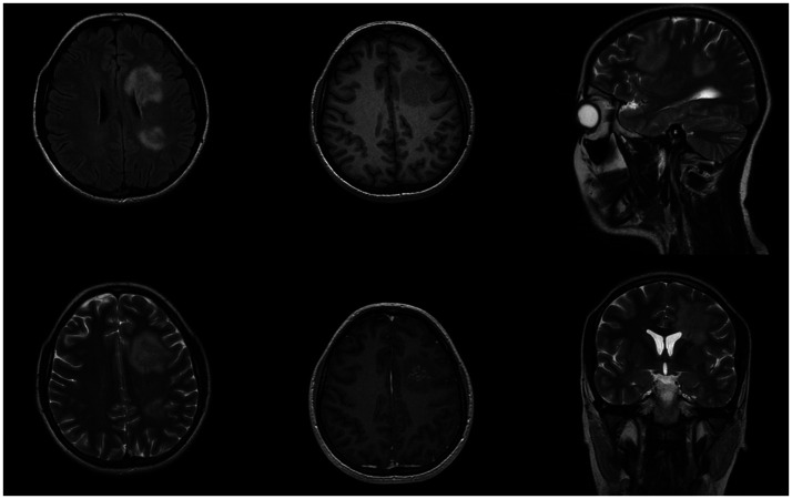 Diagnostic challenges in SLIPPERS syndrome: Case report.
