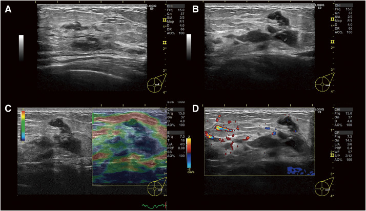 A Case of Cystic Neutrophilic Granulomatous Mastitis in Which <i>Mycobacteroides abscessus</i> Was Detected.