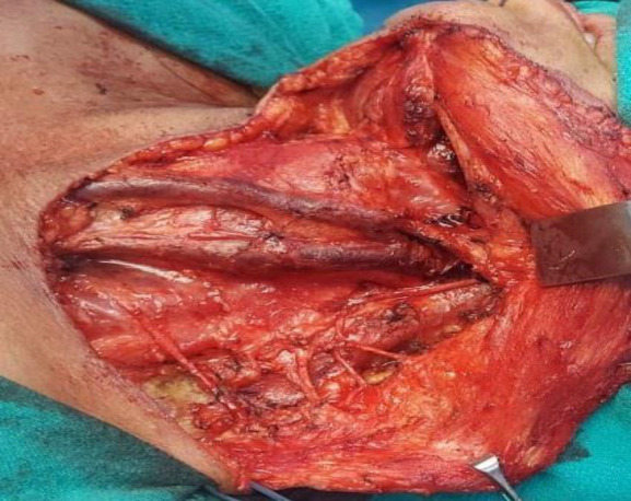 Internal Jugular Vein Duplication: A series of Seven Cases and Review of Literature.