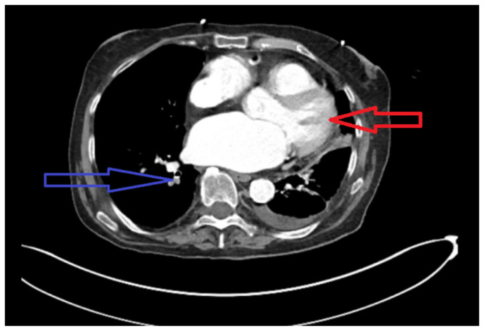 Pulmonary Embolism in Long Standing Diabetes: A Hint Towards Pancreatic Carcinoma.