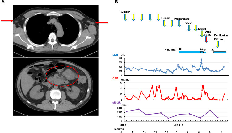ALK-negative anaplastic large cell lymphoma with TP53 mutation developing during the administration of baricitinib for atopic dermatitis - A case report.