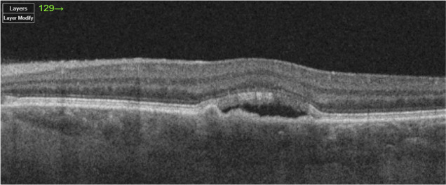 Optical coherence tomography: an introduction.