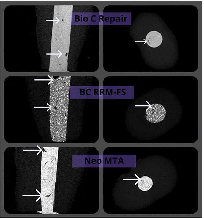 Micro-CT Analysis of Apical Plug Using Various Premixed Bio-ceramic Putties: An In Vitro Study.