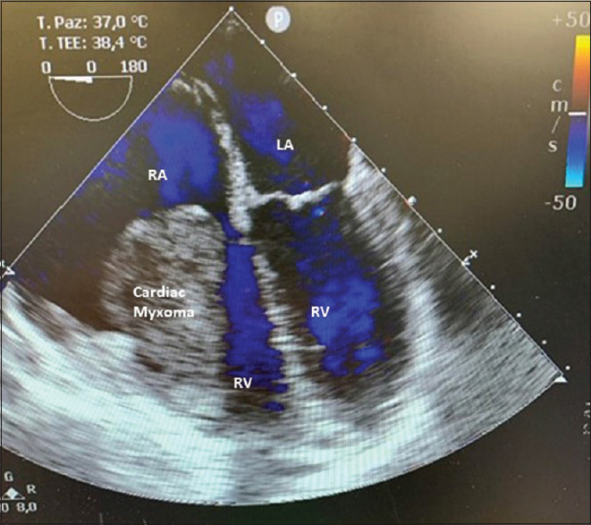 Right Ventricular Myxoma Presenting in a Patient With Known Arteriovenous Malformations in the Brain: A Case Report.
