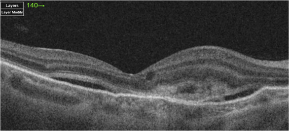 Optical coherence tomography: an introduction.