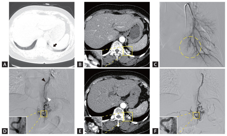 Growing chronic consolidative lesion with an air bronchogram.