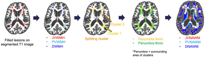 Associations between cerebral blood flow and progression of white matter hyperintensities.