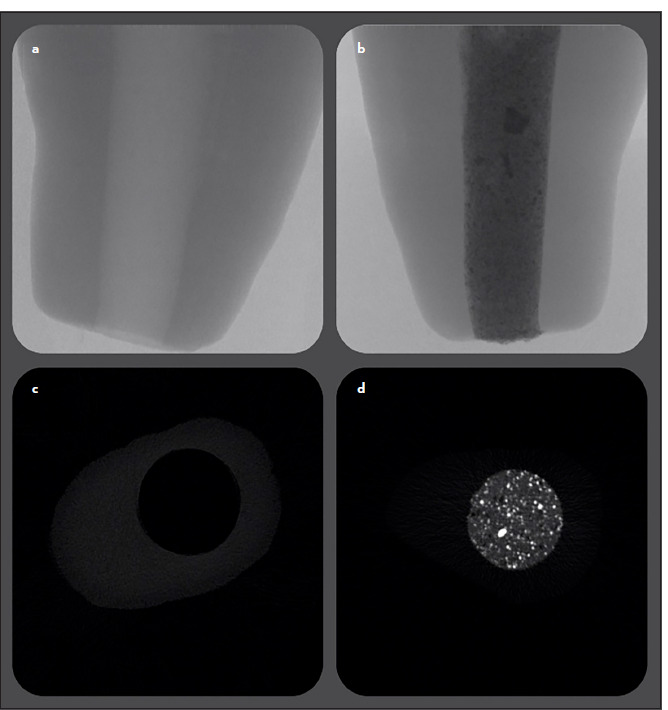 Micro-CT Analysis of Apical Plug Using Various Premixed Bio-ceramic Putties: An In Vitro Study.