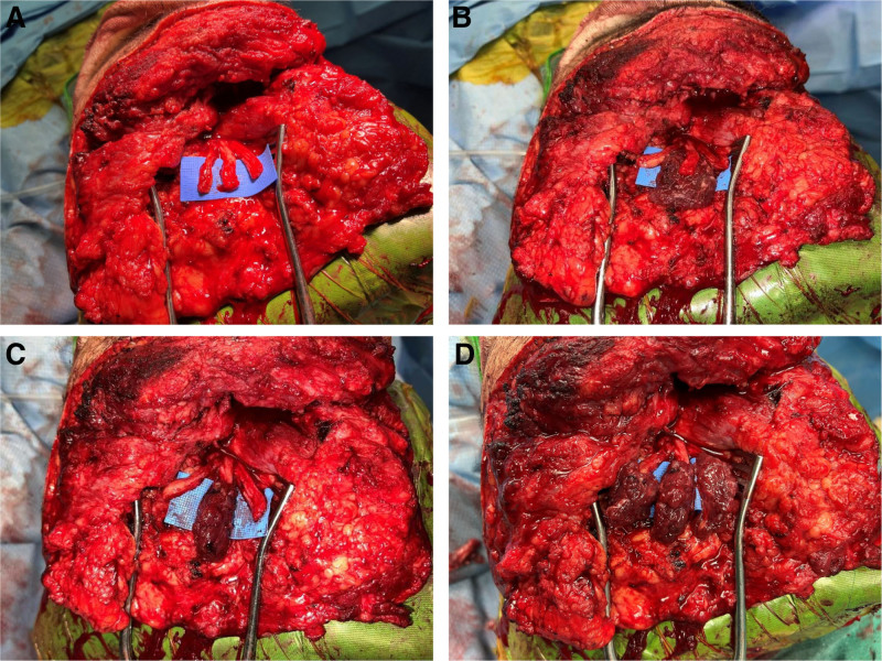 Regenerative Peripheral Nerve Interface Surgery to Treat Chronic Postamputation Pain: A Prospective Study in Major Lower Limb Amputation Patients.