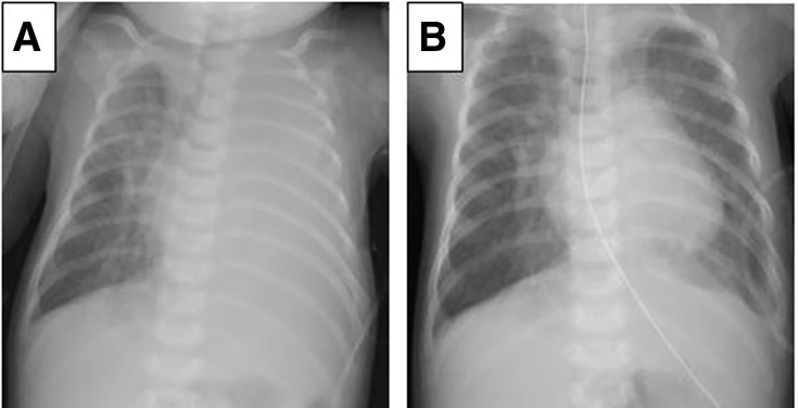 The Usefulness of Intraoperative Indocyanine Green Fluorescence Imaging in Surgical Treatment of Refractory Chylothorax in Pediatric Patients: A Case Report.