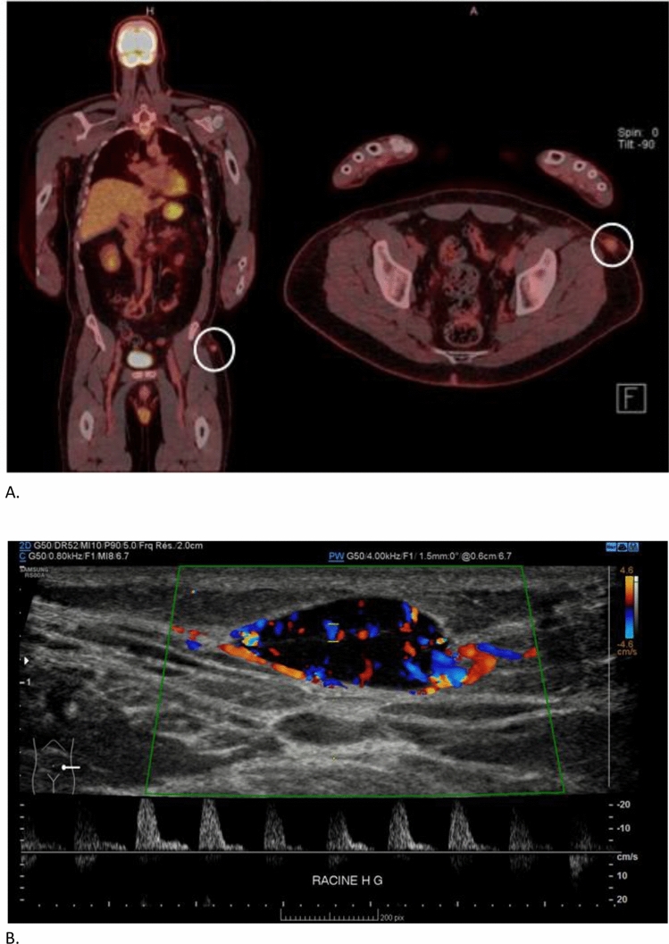 Unusual Association of Partial Fanconi Syndrome and Tumor-Induced Osteomalacia Revealed by Multiple Vertebral Fractures.