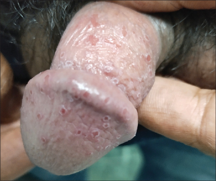 A conundrum of recurrent pustular lesions of the glans.