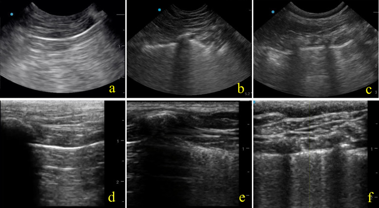 Inter-rater agreement and characterization of pleural line and subpleural fields in canine lung ultrasound: a comparative pilot study between high-frequency linear and curvilinear transducers using B- and M-mode ultrasonographic profiles.