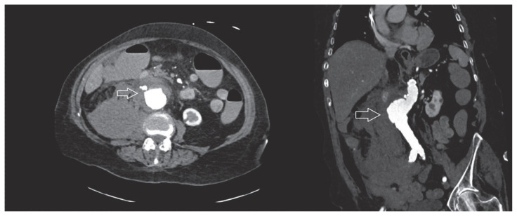 Staphylococcus aureus-related fatal abdominal aortitis case.