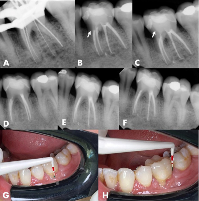 Efficacy of Biodentine as an Intraorifice Barrier in a Cracked Tooth with Endo-periodontal Lesions: A Case Report.