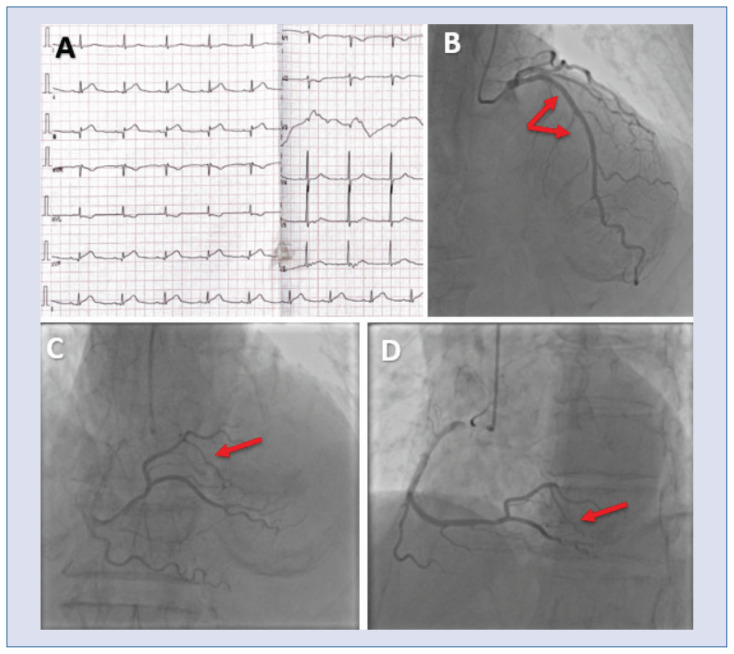Paradoxical embolism via patent foramen ovale: a rare cause of myocardial infarction in an air traveler.