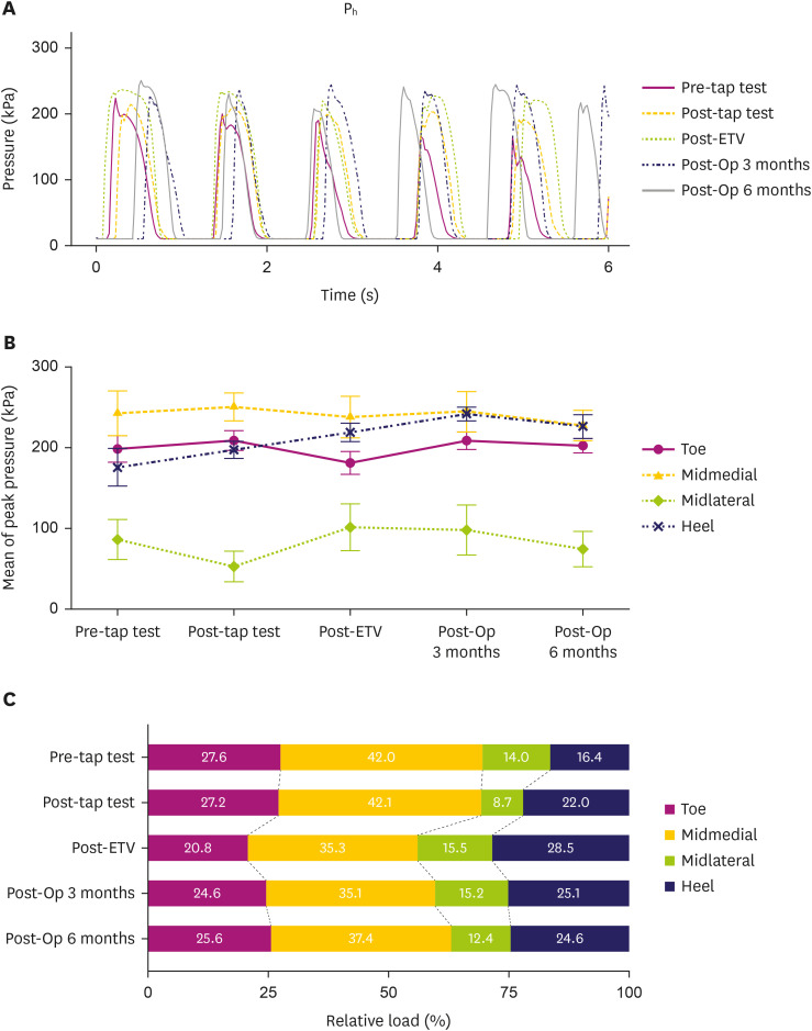 Serial Assessment of Gait Changes After Interventions Using Smart Insole in a Patient With iNPH: A Proof-of-Concept Case Report.