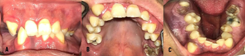 Oral Health and Dental Management Strategies in Noonan Syndrome: A Case Report.