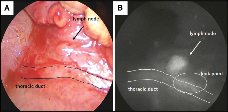 The Usefulness of Intraoperative Indocyanine Green Fluorescence Imaging in Surgical Treatment of Refractory Chylothorax in Pediatric Patients: A Case Report.