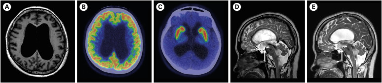 Serial Assessment of Gait Changes After Interventions Using Smart Insole in a Patient With iNPH: A Proof-of-Concept Case Report.
