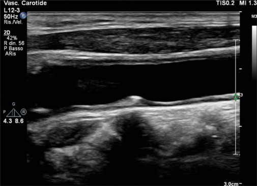 The Role of Imaging in Cardiovascular Prevention: A Comprehensive Review.