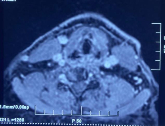 Internal Jugular Vein Duplication: A series of Seven Cases and Review of Literature.