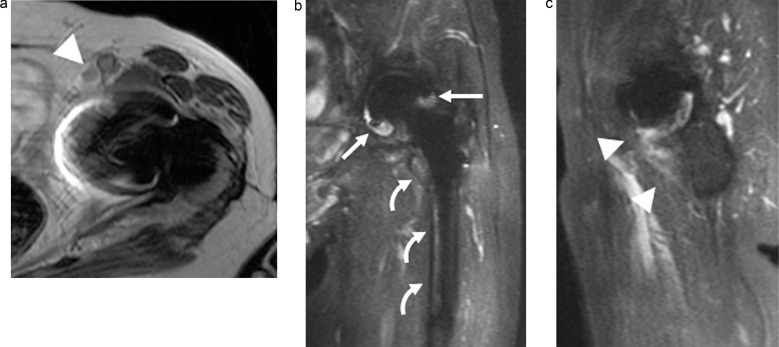 Evaluating Hip Periprosthetic Joint Infection with Metal-artifact-reduction MR Imaging.