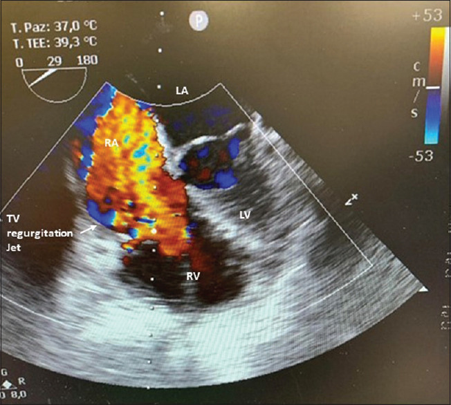 Right Ventricular Myxoma Presenting in a Patient With Known Arteriovenous Malformations in the Brain: A Case Report.