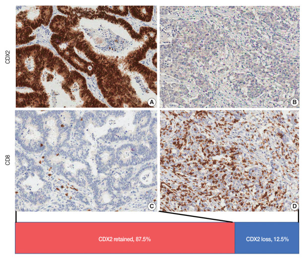 The combination of CDX2 expression status and tumor-infiltrating lymphocyte density as a prognostic factor in adjuvant FOLFOX-treated patients with stage III colorectal cancers.