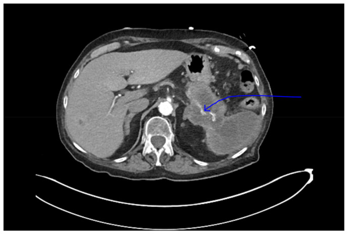 Pulmonary Embolism in Long Standing Diabetes: A Hint Towards Pancreatic Carcinoma.
