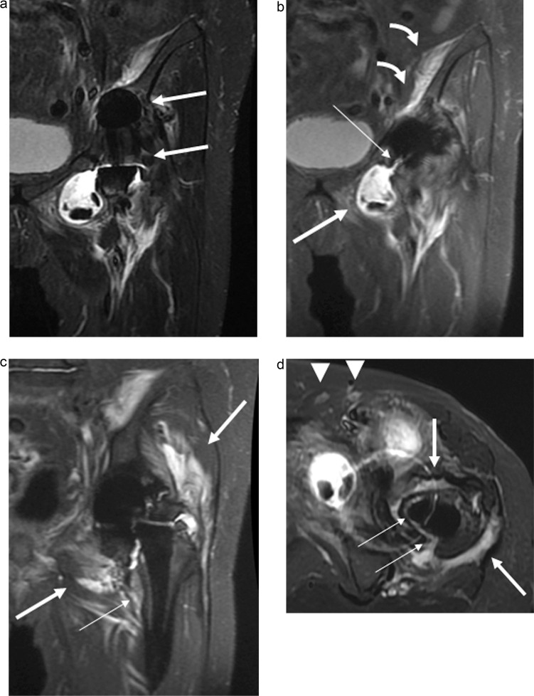 Evaluating Hip Periprosthetic Joint Infection with Metal-artifact-reduction MR Imaging.