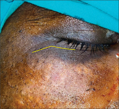 A modified high infraorbital with lateral crow feet extension incision (Punincision) for body of zygoma fractures and zygoma implants: Original research.