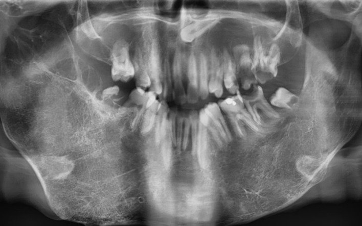 Oral Health and Dental Management Strategies in Noonan Syndrome: A Case Report.