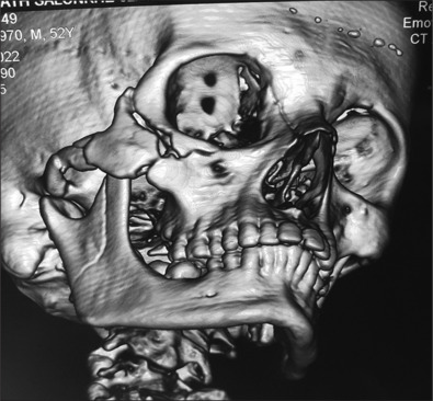 A modified high infraorbital with lateral crow feet extension incision (Punincision) for body of zygoma fractures and zygoma implants: Original research.