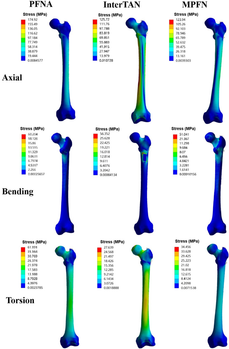 Biomechanical evaluation of the modified proximal femoral nail for the treatment of reverse obliquity intertrochanteric fractures.