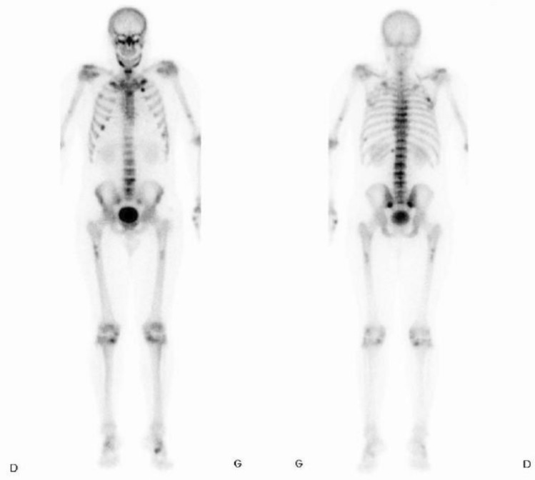 Unusual Association of Partial Fanconi Syndrome and Tumor-Induced Osteomalacia Revealed by Multiple Vertebral Fractures.