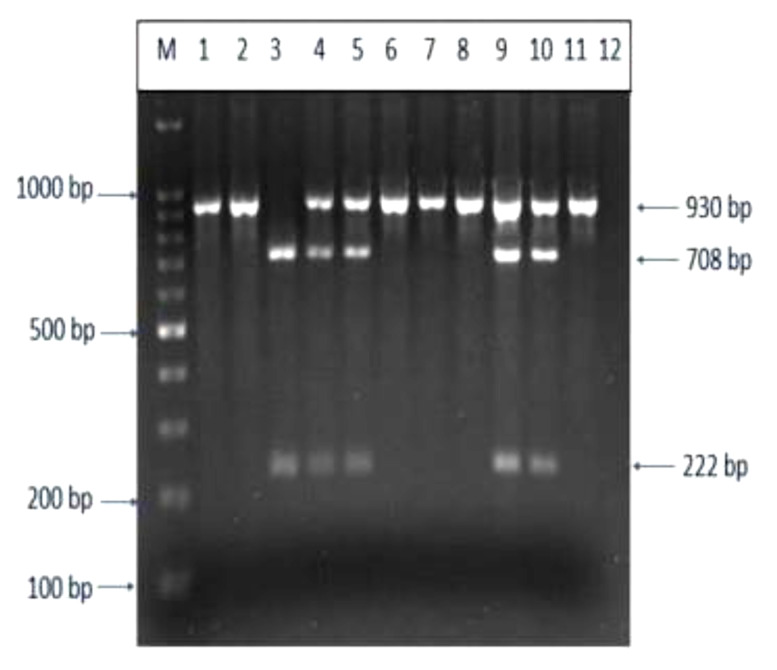 Association of The <i>MCP-1</i> rs1024611 Polymorphism with Polycystic Ovary Syndrome in A Population of Indian Women: A Case-Control Study.