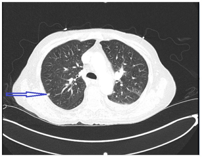 Pulmonary Embolism in Long Standing Diabetes: A Hint Towards Pancreatic Carcinoma.