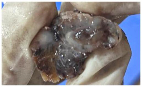 Low Grade Appendiceal Mucinous Neoplasm - A Case Series A Silent Threat with Deadly Consequences.