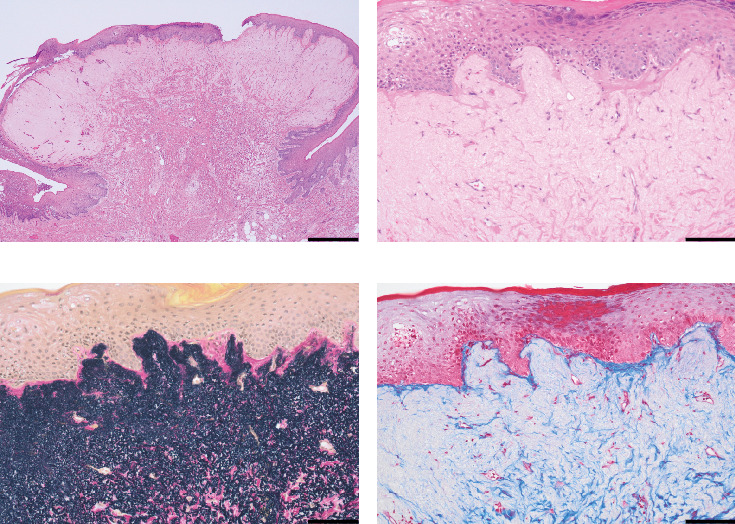 A Case of an Oral Elastofibromatous Lesion: A Clinicopathological Analysis With a Literature Review.